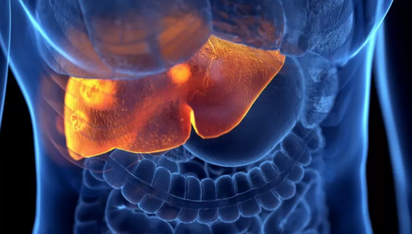 Hepatitis