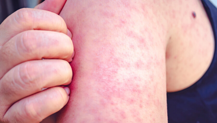Mano rasca brazo infectado por sarampion Mexico. FOTO: Getty Images